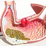 ABUZIV Magen-Anatomie-Modell – Gastritis-Modell, Modell for Magenläsionen, Demonstration von Magenerkrankungen, menschliches Verdauungssystem, medizinische Lehre, anatomisches Modell Statuendekor